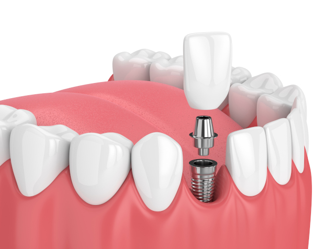 coral springs dental implants near you