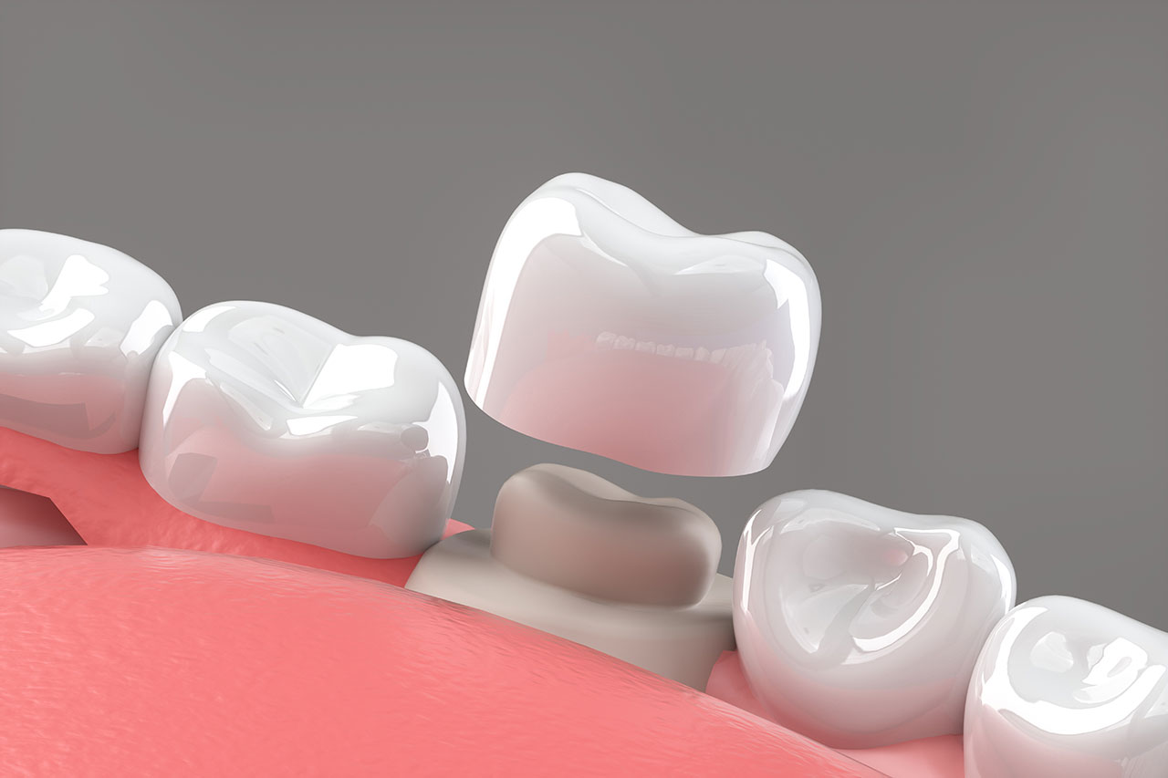 Dental Crowns In Coral Springs: Strong, Natural-Looking Protection For Damaged Teeth
