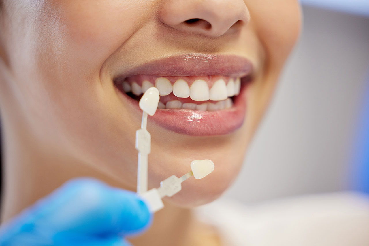 Porcelain Veneers In Coral Springs: A Polished Way To Improve Shape, Color, And Balance