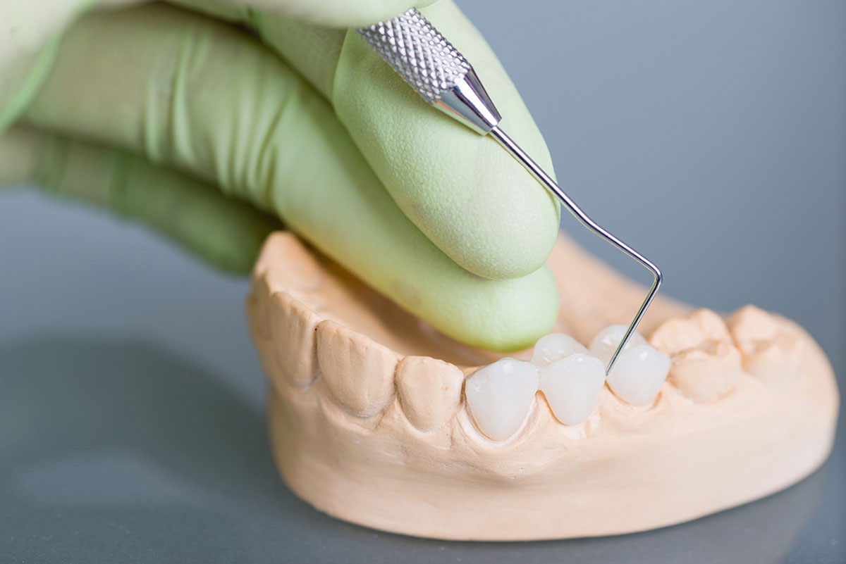Pine Ridge Dental on Wiles | Dental Bridges In Coral Springs: A Practical Solution For Replacing Missing Teeth