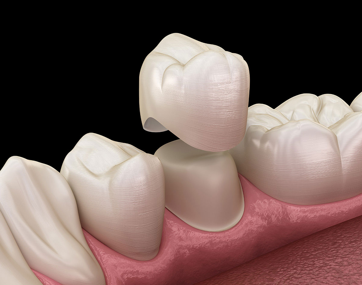 Pine Ridge Dental on Wiles | Dental Crowns In Coral Springs: How They Protect And Restore Damaged Teeth